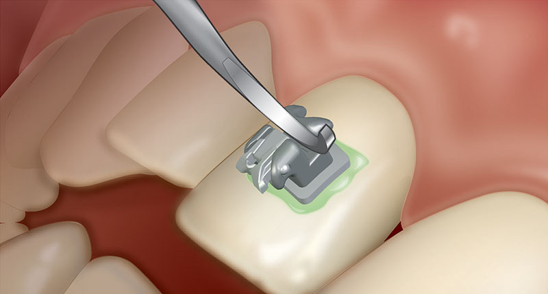 ортодонт фиксирует брекет адгезивом Grengloo