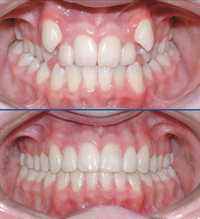 до и после выравнивания зубов