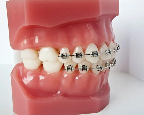 Сколько носят брекеты