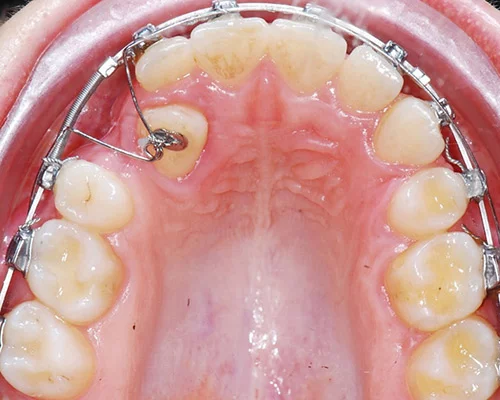 Торки. Клинические случаи