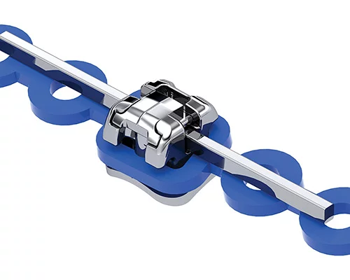 Вестибулярные брекеты