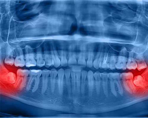 Лечение ретенированных зубов на Damon Q2 и Damon Ultima