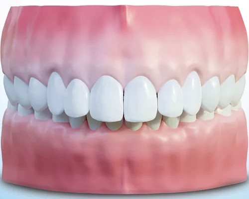 Глубокий прикус