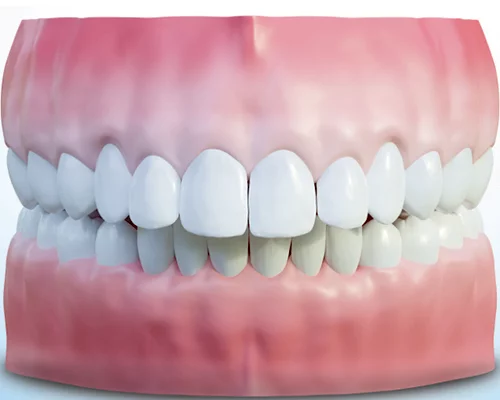 Дистальный прикус